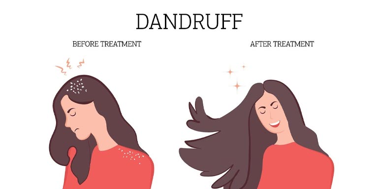 Causes of Dandruff