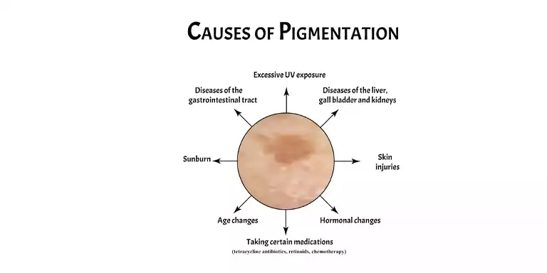Treatments to Cure Pigmentation