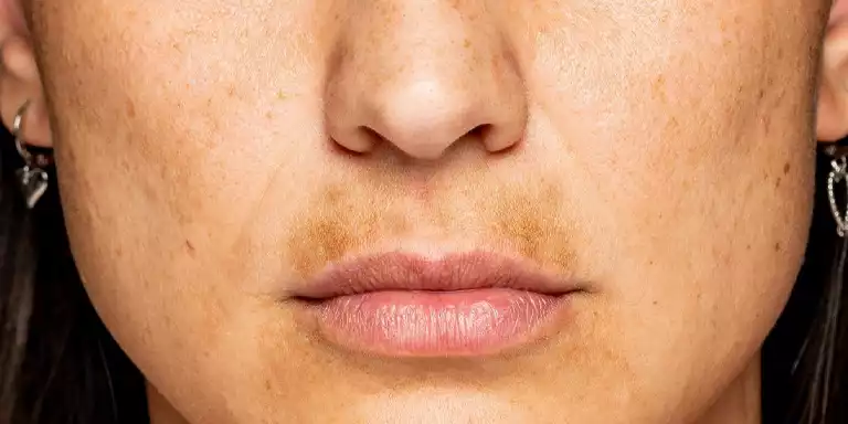 Chemical Treatments For Pigmentation