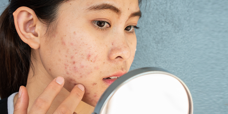 A good acne-preventer and healer