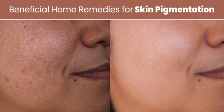 6 Skin Pigmentation Home Remedies for Clear Skin