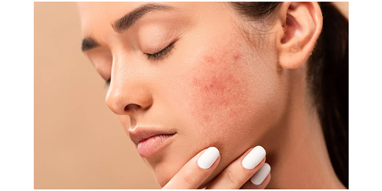 Treats Acne, Blemishes, and Blackheads