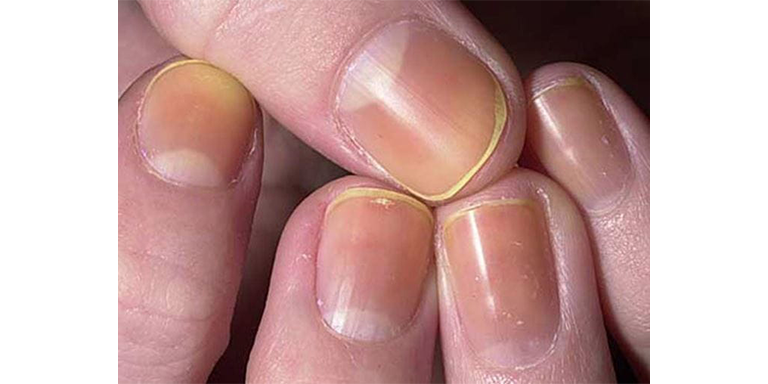 Nail Nightmares You Must Identify