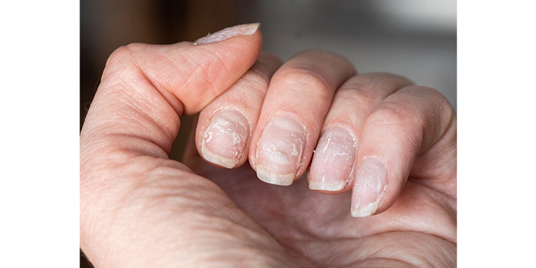 Splitting And Peeling Nails