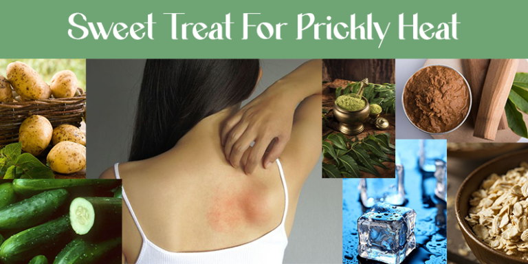 9 Home Remedies For Prickly Heat Treatment