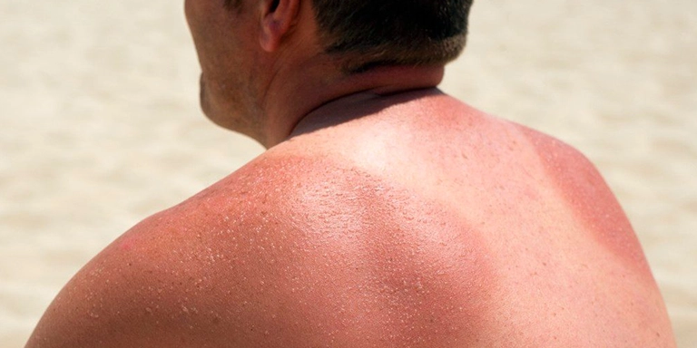 Stops Sunburn by Sunscreen