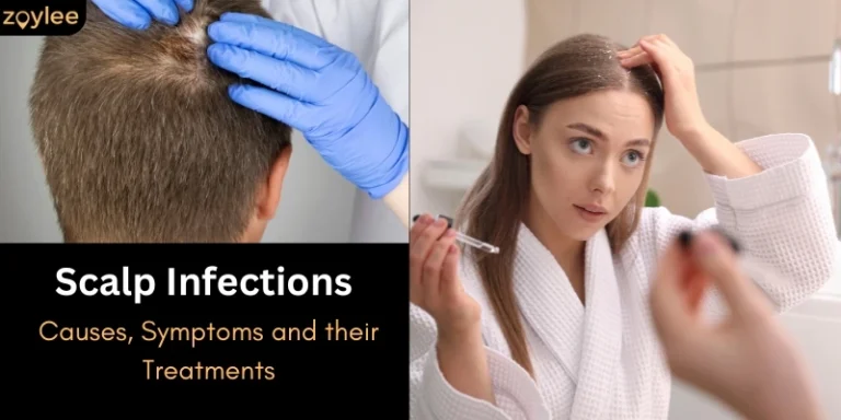 Scalp Infections: Causes, Types, Symptoms and Their Treatments